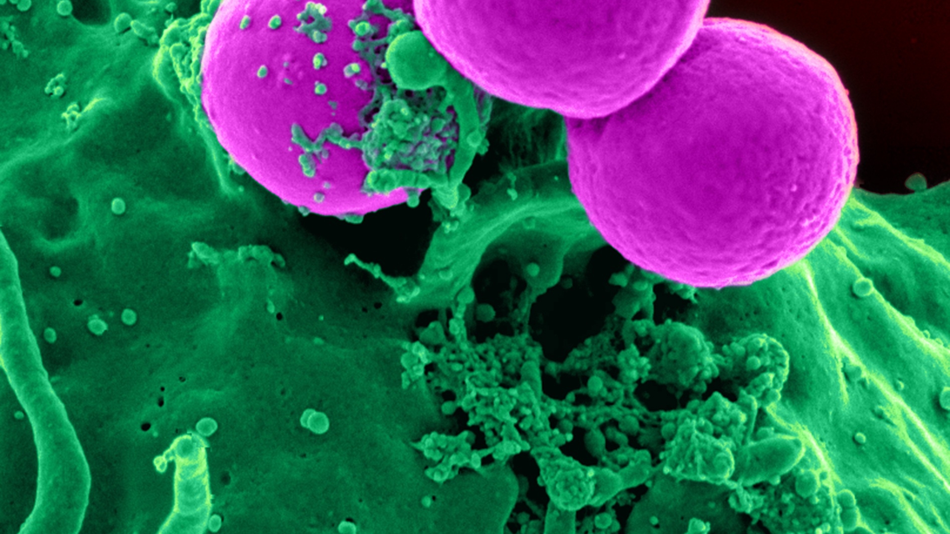 Ученые разработали новый способ удаления раковых клеток из ткани