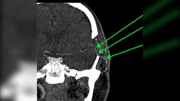 Подмосковные нейрохирурги сохранили жизнь пациента после тяжелого инсульта
