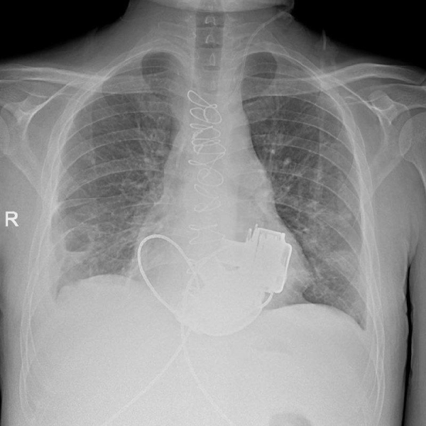 Пациент без пульса выйдет из стен петербургской больницы